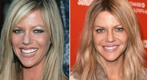 Kaitlin Olson's before and after plastic surgery photos